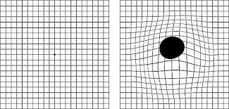 An Amsler grid showing mild distortion.