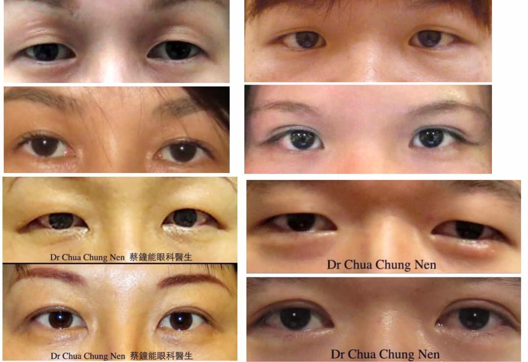 Double eyelid surgery deals malaysia